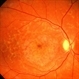 Fundus Flavimaculatus Fundus Flavimaculatus